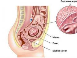 Проблемы с плацентарным и маточным кровотоком Плохое кровоснабжение мозга на 26 неделе беременности